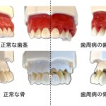 正常と歯周病の模型の比較写真