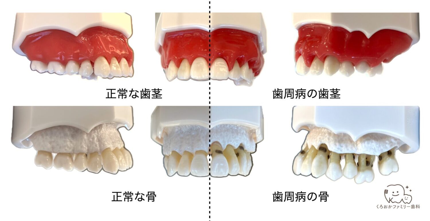 正常と歯周病の模型の比較写真