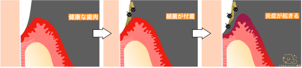 歯周病が進行する図
