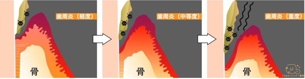 歯周病により骨が溶けていく図