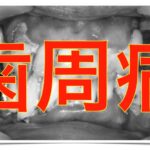 歯周病の写真