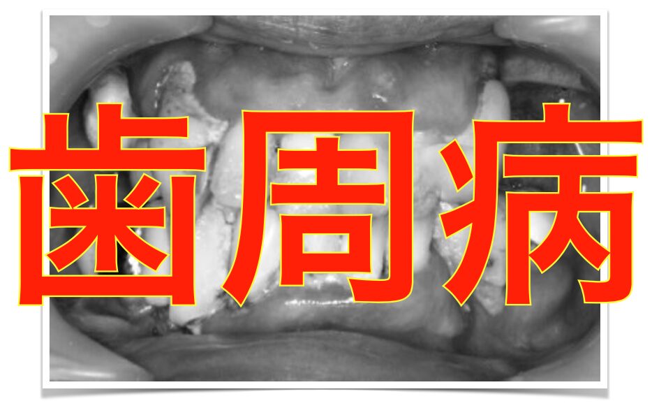 歯周病の写真
