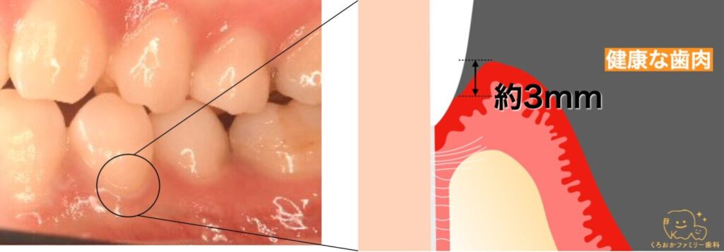 歯周ポケットの解説図