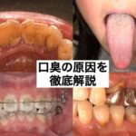 口臭の原因の写真