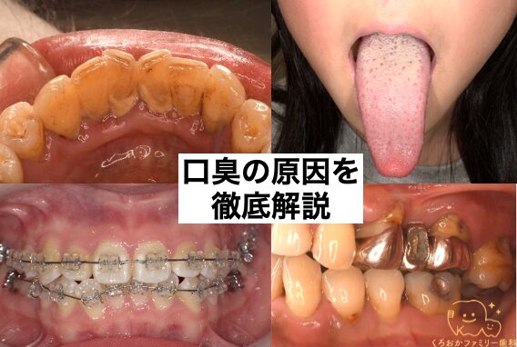 口臭の原因の写真