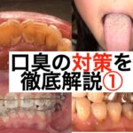 口臭の原因を徹底解説①