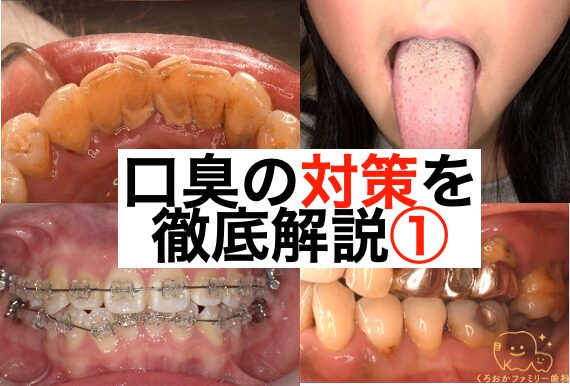 口臭の原因を徹底解説①