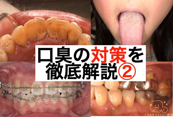 口臭の対策を徹底解説②
