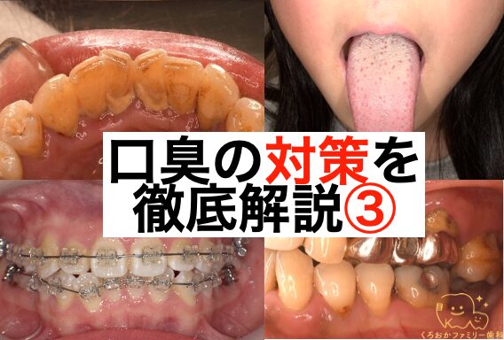 口臭の対策を徹底解説③