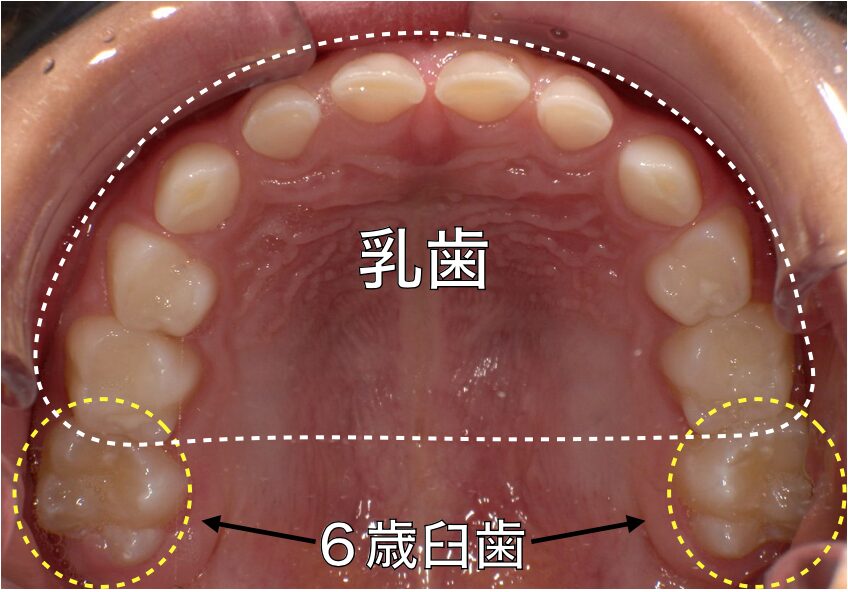 歯の生え変わり−永久歯−6歳臼歯